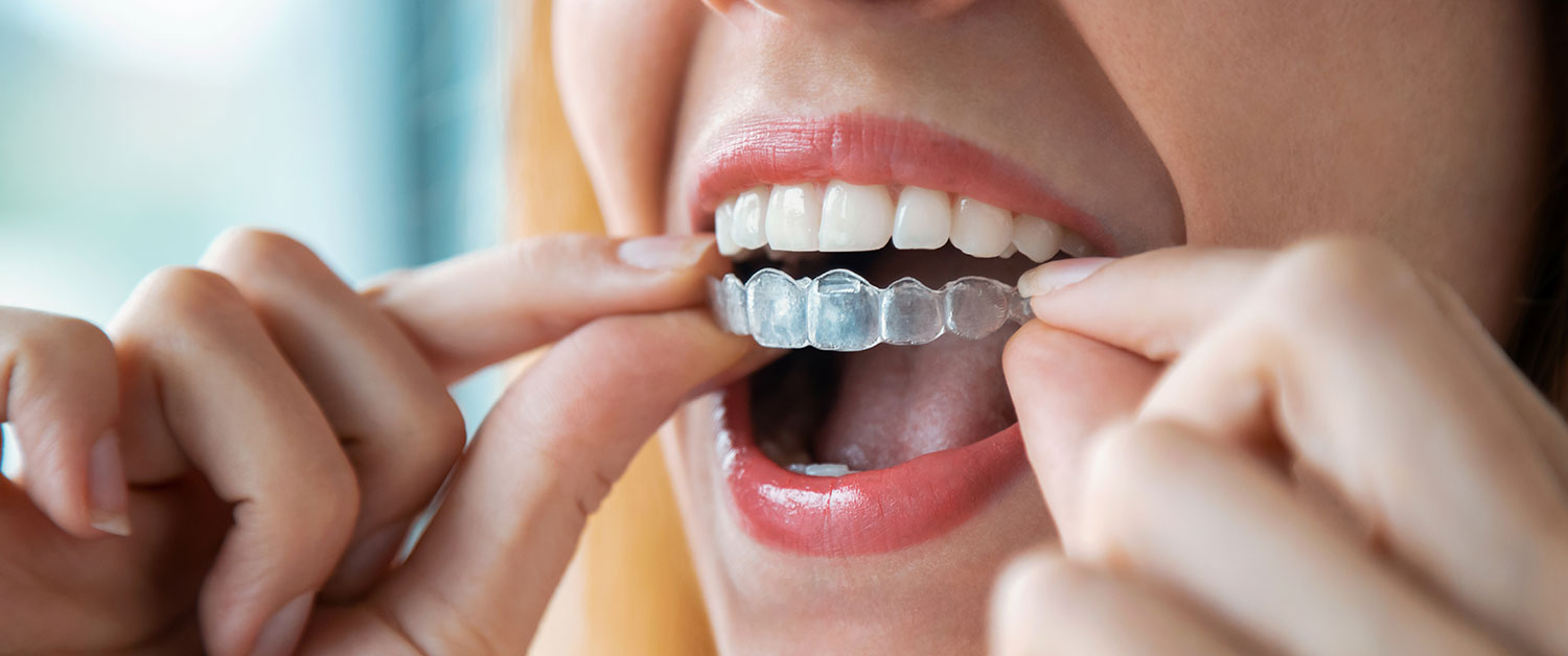 Close-up of a person’s mouth as they use their fingers to insert a clear orthodontic aligner over their upper teeth.